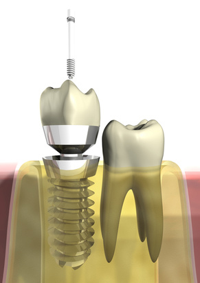 Zahnarztpraxis Dr. Sievers Implantologie